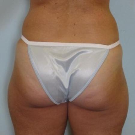 Before image 2 Case #82731 - Liposculpture - hips and thighs