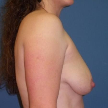 Before image 3 Case #80716 - Breast Lift with Augmentation