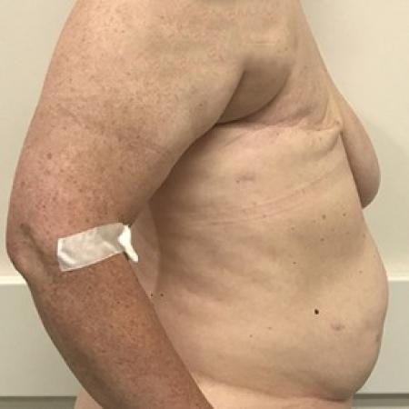 Before image 2 Case #87631 - DIEP Flap Breast Reconstrution