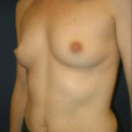 Before image 2 Case #82891 - Breast Augmentation using Smooth Round Silicone Gel Implants