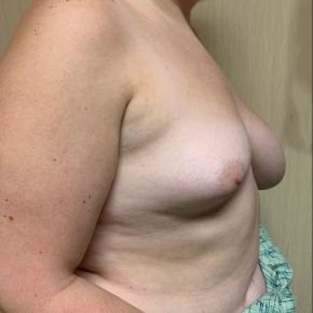 Before image 2 Case #88191 - Left Breast Reduction and Right Breast Augmentation on a 22 year old patient