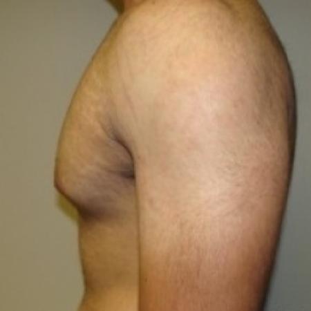 Before image 3 Case #79046 - Gynecomastia