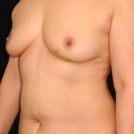 Before image 2 Case #82961 - 52 y/o - Immediate DIEP Flap Breast Reconstruction