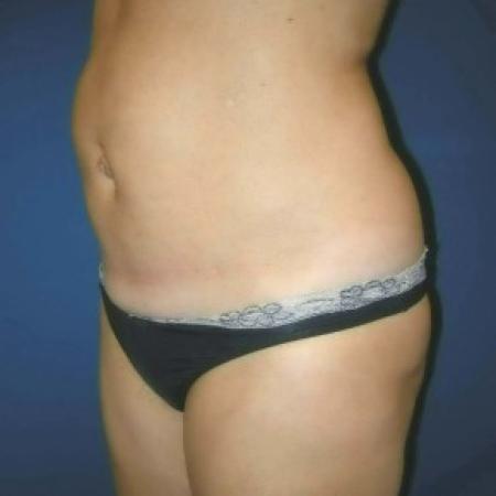 Before image 2 Case #82821 - Tummy Tuck and Liposuction of Hips