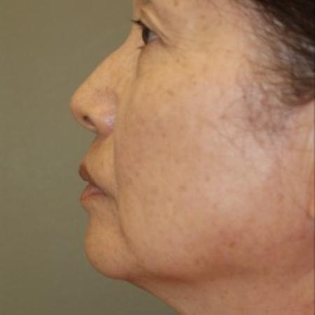 Before image 3 Case #81911 - Facelift