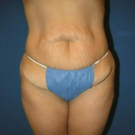 Before image 1 Case #82816 - Extended Tummy Tuck and Liposuction