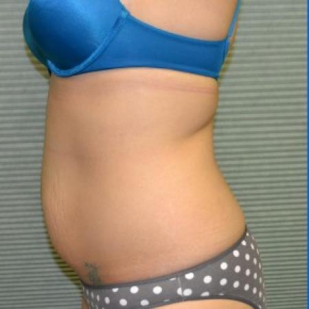 Before image 2 Case #87836 - Tummy Tuck and liposuction of flanks