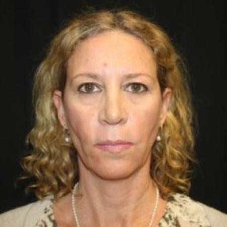 Before image 1 Case #85271 - Facelift and Neck Lift - 49 year old female