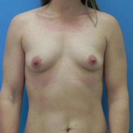 Before image 1 Case #86641 - Submuscular Breast Augmentation 330cc on Left Side - 315cc on Right Side - Medium Height - Moderate Plus Projection Silicone Gel Implants