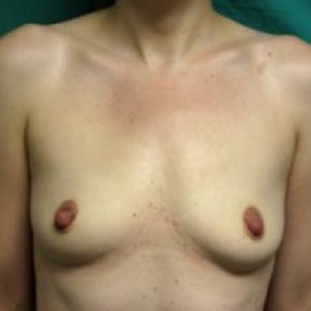 Before image 1 Case #85786 - Breast Augmentation 