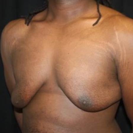 Before image 2 Case #83056 - 22 year old Gynecomastia