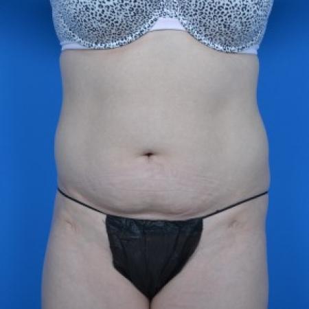 Before image 1 Case #87946 - Tummy Tuck