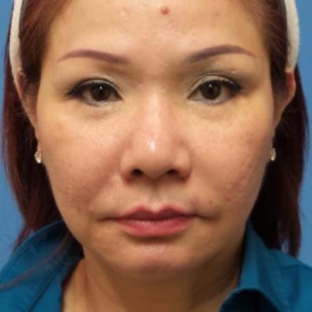 Before image 1 Case #86586 - Facelift