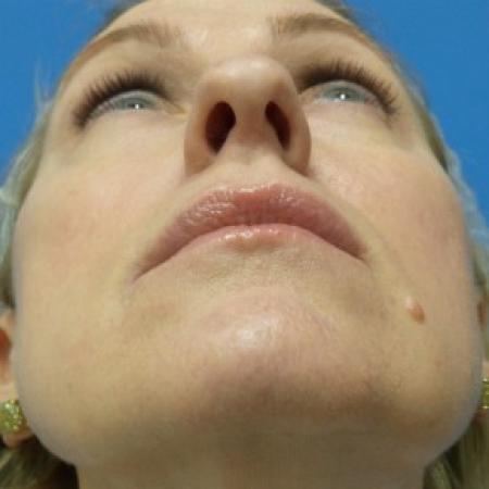 Before image 4 Case #87096 - 49 year old  -  Rhinoplasty/Septoplasty/Turbinectomy  -  3 months post-op
