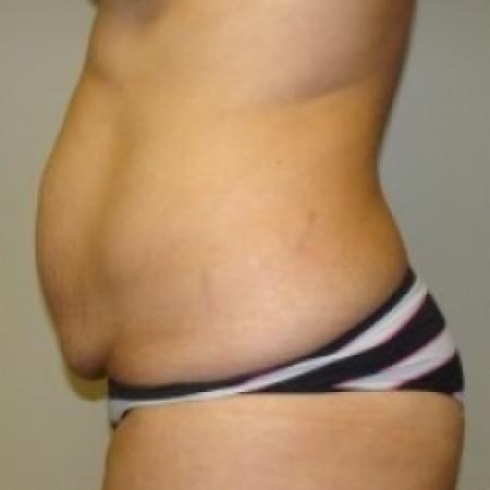 Before image 3 Case #79491 - Tummy Tuck