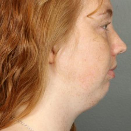 Before image 2 Case #83621 - Liposuction Neck with Chin Implant