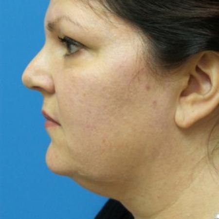 Before image 2 Case #87161 - 47  year old  -  SkinTite with J-Plasma RF & Liposuction of Neck  -  2 months post-op