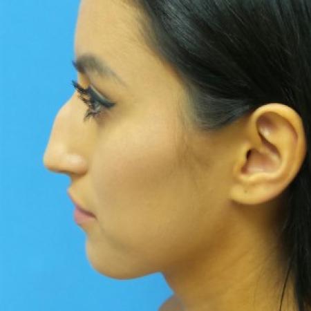 Before image 3 Case #87301 - 23-year old - Open Rhinoplasty - 3 months post-op