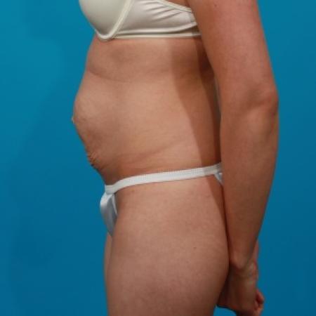 Before image 3 Case #79296 - Tummy Tuck