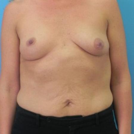 Before image 1 Case #81846 - Breast Augmentation with Mastopexy (Breast Lift)