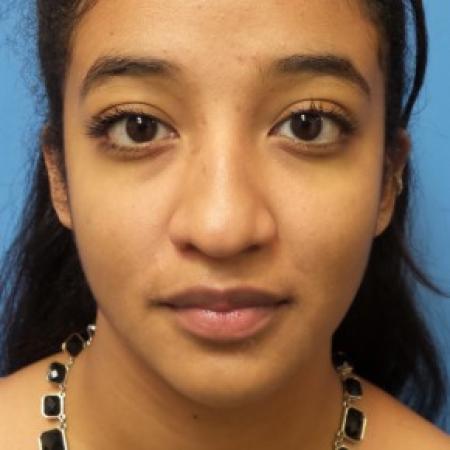 Before image 1 Case #86471 - Rhinoplasty/Septoplasty/Turbinectomy - 1 year post-op