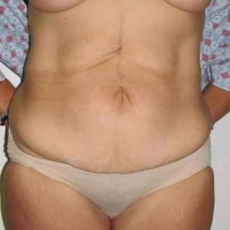 Before image 1 Case #85806 - Massive weight loss patient with Fleur-de-Lis abdominoplasty