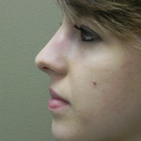 Before image 2 Case #81881 - Open Structure Septorhinoplasty
