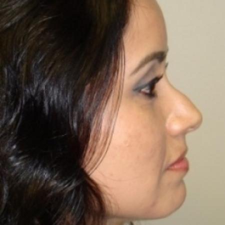Before image 5 Case #79041 - Rhinoplasty
