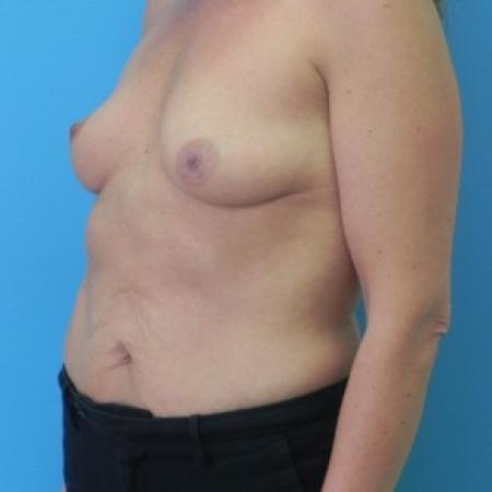 Before image 2 Case #81846 - Breast Augmentation with Mastopexy (Breast Lift)