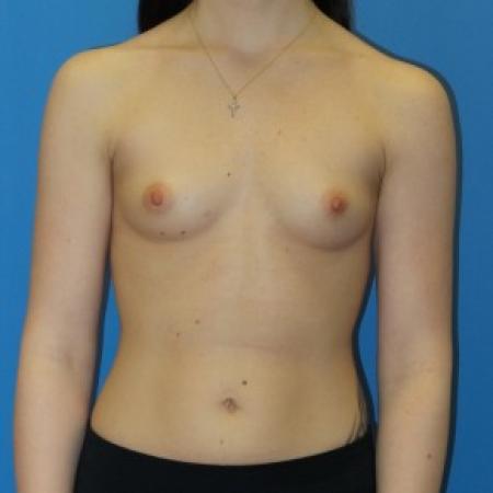 Before image 1 Case #86651 - Submuscular Breast Augmentation 390cc Shaped - Medium Height - High Profile Silicone Gel Implants