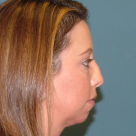 Before image 3 Case #86736 - Rhinoplasty+ chin augmentation with silicone implant