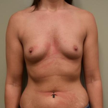 Before image 1 Case #86846 - Submuscular Breast Augmentation with Soft Touch Round Cohesive Silicone Implants