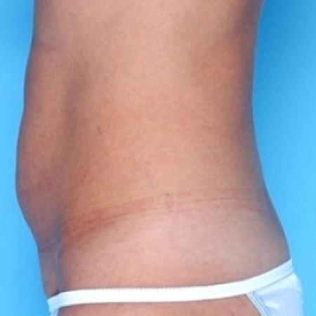 Before image 2 Case #79166 - Tummy Tuck