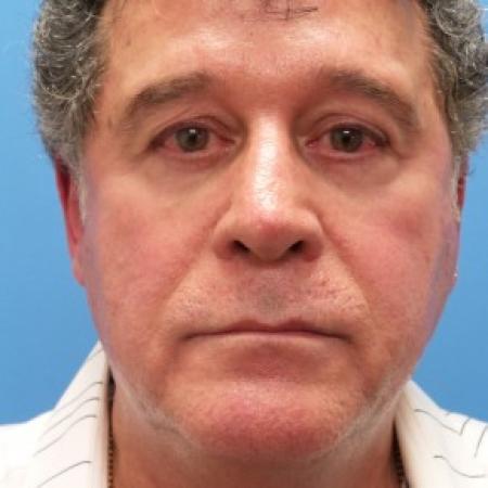 Before image 1 Case #86716 - Facelift/Upper Blepharoplasty/Browlift - 1 year post-op