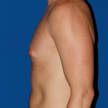 Before image 3 Case #79986 - Gynecomastia male breast reduction