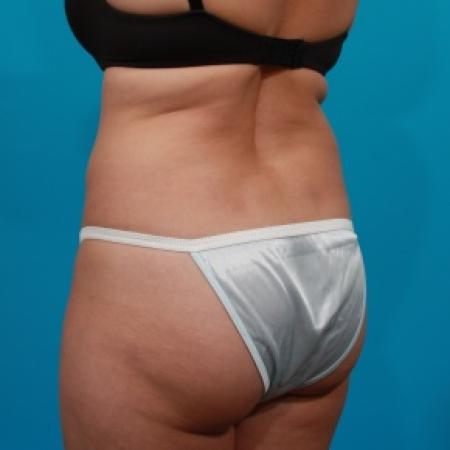Before image 4 Case #80771 - Tummy Tuck & Flank Liposuction