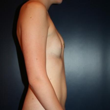 Before image 3 Case #86261 - severe breast assymmetry