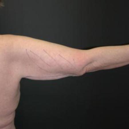Before image 1 Case #80896 - Brachioplasty Procedure