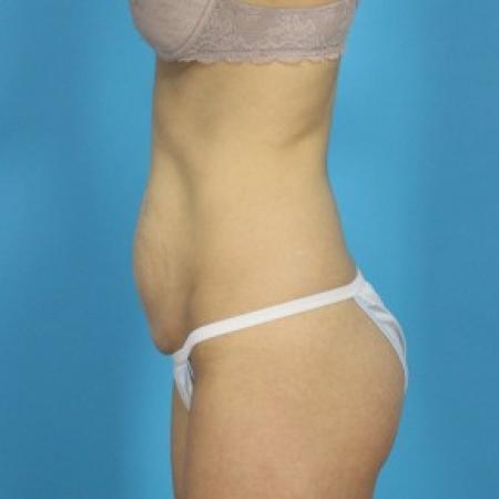 Before image 3 Case #84081 - Abdominoplasty