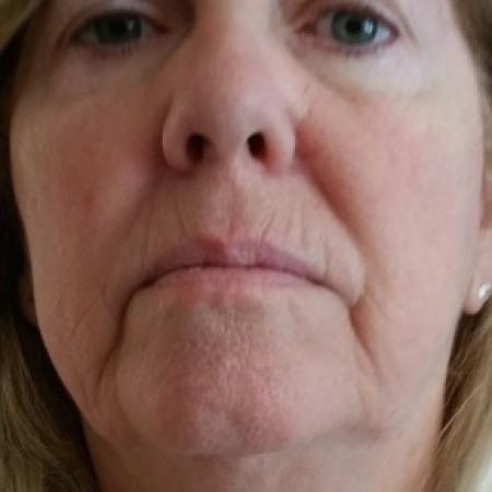 Before image 1 Case #82381 - Juvederm for smile lines