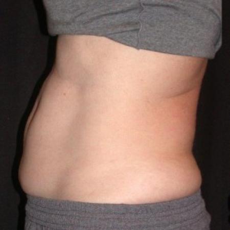 Before image 2 Case #81866 - CoolSculpting