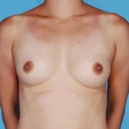 Before image 1 Case #79126 - Silicone 