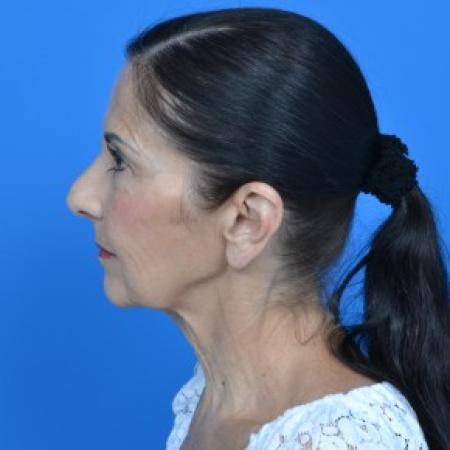 Before image 5 Case #88061 - Facelift and Neck Lift