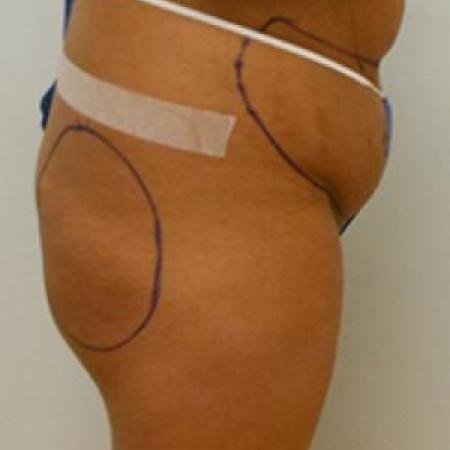 Before image 1 Case #84911 - Buttock Augmenation with implants and liposuction of the abdomen