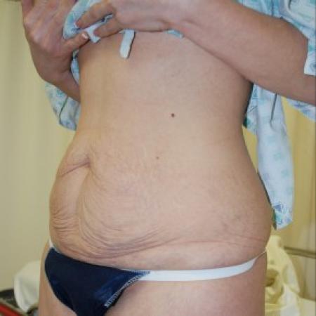 Before image 2 Case #85811 - Traditional abdominoplasty after children
