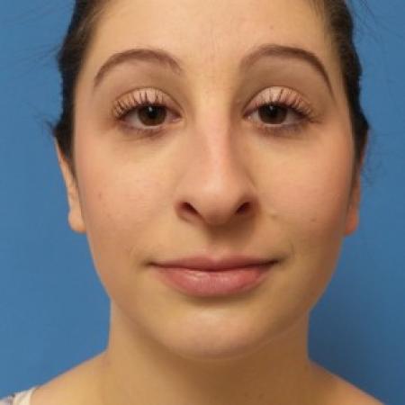 Before image 1 Case #86461 - Rhinoplasty