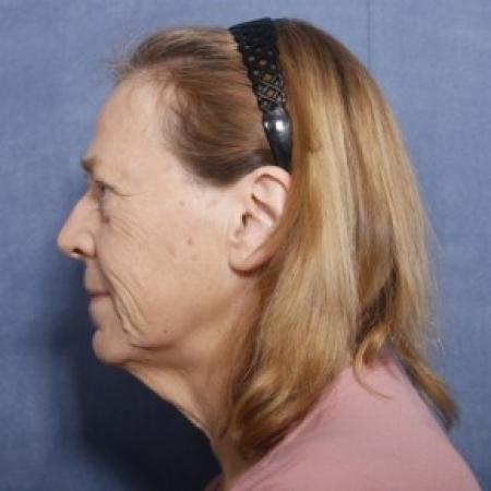 Before image 2 Case #83716 - 60 Year Old Female
