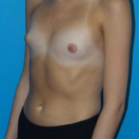 Before image 2 Case #86421 - Submuscular Breast Augmentation 295cc High Cohesive Silicone Gel Implants