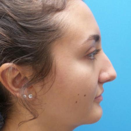 Before image 3 Case #88381 - 21 year-old  -  Rhinoplasty  -  4 months post-op