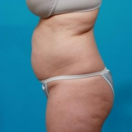 Before image 3 Case #78856 - Abdominoplasty & Flank Liposuction